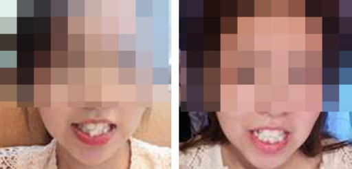 后牙美学树脂充填（美学树脂补牙800元贵吗）